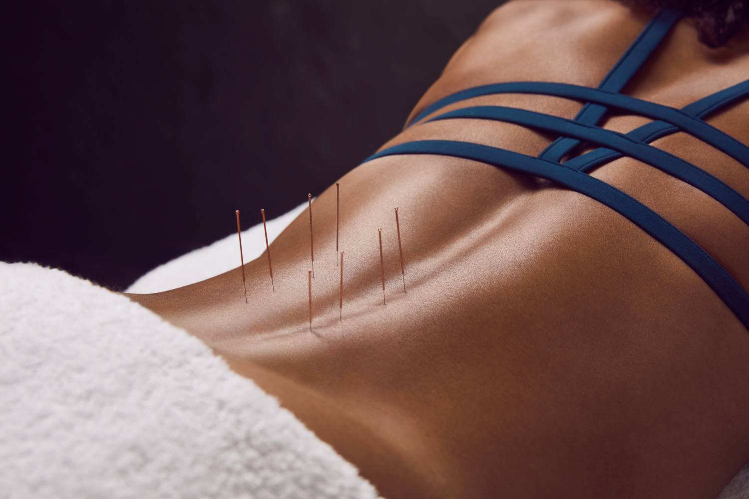 Dry Needling at Third Space Sports Med